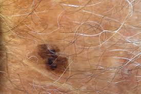 Image result for Macule