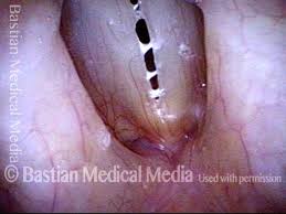Image result for Reflux Laryngitis