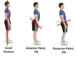 Image result for tight hamstrings and anterior pelvis tilt