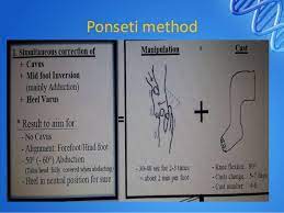 Check spelling or type a new query. Management Of Club Foot