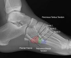 When the fracture happens, the tendon or these fractures most often affect bones in the elbow, hip, and ankle. 5th Metatarsal Base Fracture Foot Ankle Orthobullets