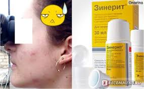 как убрать пигментные пятна на лице в домашних условиях отзывы Uhod Za Licom V Domashnih Usloviyah Kremy Maski Skraby Pilingi I T D Ya Navsegda Izbavilas Ot Pryshej A Takzhe Znayu Kak Osvetlit Pigmentnye Pyatna Vesnushki Ubrat Chernye Tochki I Suzit Pory