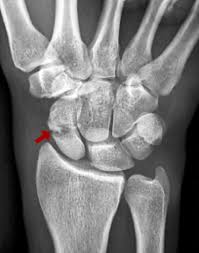 Image result for Scaphoid Fracture Signs