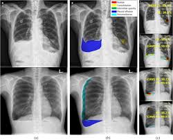 Chest x ray for diagnosis of lung cancer, normal chest x ray, normal chest pa and lat radiographic views chest x ray a, chest xray normal healthy man chest radiograph wikipedia. A Curriculum Learning Strategy To Enhance The Accuracy Of Classification Of Various Lesions In Chest Pa X Ray Screening For Pulmonary Abnormalities Scientific Reports