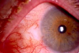 Image result for lesion sclera