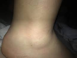 Wann muss man zum arzt, wenn man sich am kopf verletzt hat? Bin Heute Umgeknickt Ist Mein Fuss Gebrochen Sieht Bild Knochen Gelenke Knochel