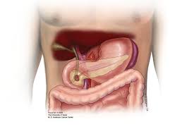 Stomach ulcer or gastric ulcer is a painful open sore that develops on the lining of your stomach due to the damage to the inner stomach lining. Whipple Procedure Pancreaticoduodenectomy Pancreatic Cancer Action Network