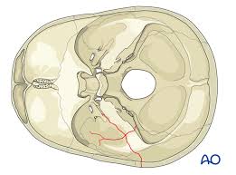 Image result for Temporal Bone
