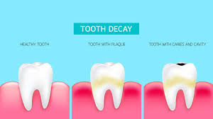 You may not have any symptoms at first. The Five Stages Of Dental Decay Trublu Dentistry