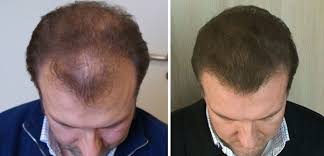 Because hair loss or alopecia, as it's medically termed, is traditionally thought to only affect men, many women are shocked when they learn they are prone to this aga is the type of hair loss most commonly associated with men but, in fact, approximately 50% of women develop it during their lifetime. My Hair Has Been Falling Out A Lot It S Very Thin Now I Feel Very Unattractive What Can I Do Quora