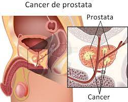 Poate 1.500 euro , nu 15.000. Crioterapia In Cancerul De Prostata