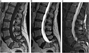 Cauda equina syndrome may result from any lesion that compresses ce nerve roots. Mri Of Inflammatory Spondyloarthropathy Following Traumatic Cauda Equina Syndrome Spinal Cord