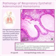 Educational Gif Pathology Of Respiratory Epithelial Adenomatoid Hamartoma Respiratory Pathology Nasal Obstruction