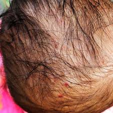 Itchy bumps on the arms is a condition in which small bumps develop on the skin and cause itching and irritation. My Baby Is Getting Little Itchy Small Bumps On Her Scalp Causing Her Irritation And Every Day One Or Two Are Breaking With Blood Image Is Attached And Please Help Firstcry