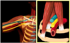 How To Truly Identify And Treat Thoracic Outlet Syndrome Tos Msk Neurology