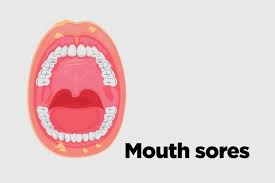 Oral and oropharyngeal cancer can often be cured, especially if the cancer is found at an early stage. Oral Cancer Symptoms 13 Signs You Might Ignore The Healthy