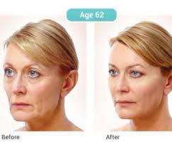 If You Have Problems With Wrinkles And Sagging Facial Skin Do Not Worry In The Following Text We Will Pres Natural Face Cleanser Natural Skin Tightening Skin