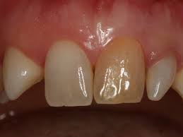 Zahnarzt Kempten Dr Nussbaumer Schone Zahne Bleaching Veneers