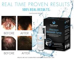 Buy Regenepure Shampoos And Hair Regrowth Products Hair Loss Tackling Shampoo Men 5 Minoxidil Hair Growth Spray Biotin Hair Growth Help Hair Loss Hair Loss