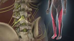 Image result for icd 10 code for radiculopathy leg