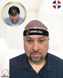 Hear Melvin's Life-Changing Hair Transplant Story at Confident Hair