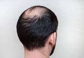 Karena rambut rontok mungkin merupakan tanda awal penyakit, adalah penting untuk mencari penyebabnya sehingga dapat diubati. 7 Cara Alami Mengobati Rambut Rontok Akibat Penyakit Kebotakan