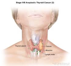 Your lymph nodes play a vital role in your body's ability to fight off infections. Endocrine Surgery Thyroid Cancer