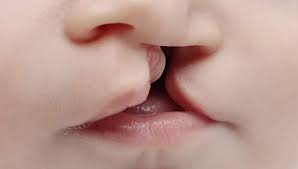 Image result for Cleft Lip