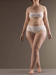 Retentia de apa afectează mult mai des femeile, pentru care fluctuațiile nivelului de hormoni (în principal estrogen) sunt considerate principala cauză cele mai frecvent utilizate metode de tratament pentru retentia de apa sunt: Cum Stii Ca Suferi De Retentie De Apa Infuzie De SÄnÄtate