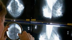 breast cancer Picture