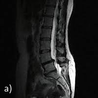 Also ich will keine diagnose, nur wissen ob das mrt bild so aussieht wie andere auch und was die weißen stellen bedeuten. Upright Mrt De Hochstgradige Spinale Enge Im Bereich Der Lws
