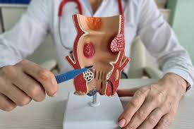 Image result for Hemorrhoid