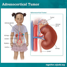 Surgery to relieve signs and symptoms. Adrenocortical Tumor In Children And Teens Together