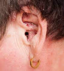 Ear infection or ear canal blockage. Ear Problems Psoriasis Tinnitus Earache Ear Wax