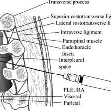 Image result for Intrapleural Anesthesia