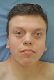 Pallister–Killian Syndrome versus Trisomy 12p—A Clinical Study of 5 New  Cases and a Literature Review