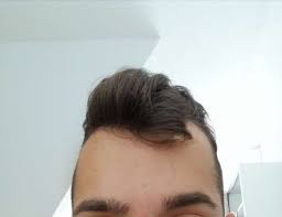 Andere frisuren können wiederum dafür sorgen, dass das problem hervorgehoben wird. Machen Mich Meine Geheimratsecken Hasslich Haare Beauty Frisur