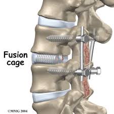 Pin By Ted Pruitt On Misc Spine Surgery Spinal Fusion Surgery Spinal Fusion
