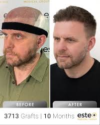 10 months later, Jeffrey Chambers' transformation is simply incredible! 💯  With 3713 grafts, his hair transplant journey has delivered amazing  progress. ✨ Contact us now: 📲WhatsApp: +90 546 903 37 84 👉Website: