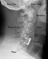 Pin By Spine Surgeon New York On Diy Cervical Radiculopathy Radiculopathy Cervical