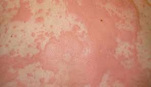 Anaphylaxis exclusion criteria · blood transfusion reactions that are not anaphylaxis · symptoms raised rash (patchy or onset over >1 hour); Hives Skin Rash Kidstart Magazine Kidstart Magazine