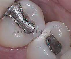 Why Do You Get Pain After A New Filling Or Restoration And How To Fix It