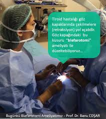 Tiroid Hastaliginin Gozu Etkileyen Tipine Graves Hastaligi Diyoruz Goz Kapaginda Graves Hastaligina Bagli Cekilmeler Retraksiyon Oldugunda B Bilgi Gozler