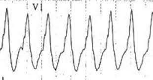 Vt Versus Svt With Aberrancy