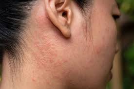 Image result for dermatitis contacta toxica