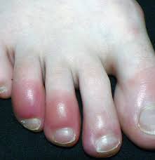 Toenail fungal infection can start from athlete's foot (foot fungus), and it can spread from one nail to another. Why Are My Toes Red Causes Other Symptoms And Treatments