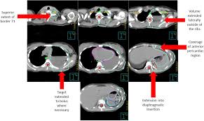 The pancreas is located behind the stomach, so having pancreatic cancer doesn't involve a palpable mass that you can feel. The Use Of Radiation Therapy For The Treatment Of Malignant Pleural Mesothelioma Expert Opinion From The National Cancer Institute Thoracic Malignancy Steering Committee International Association For The Study Of Lung Cancer And