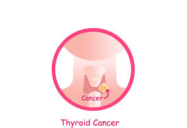 Cancer that forms in the thyroid gland (an organ at the base of the throat that makes hormones that help control heart rate, blood pressure, body temperature, and weight). Thyroid Cancer Symptoms Diagnosis Surgery Treatment And Prognosis Saint John S Cancer Institute Santa Monica Ca