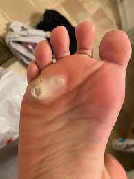 We did not find results for: Any Advice On Home Care For Plantar Wart It S My 3rd Day Using Sa And Compound W Bandages Popping