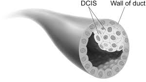 For example, carcinoma in situ of the skin, also called bowen's disease , is the accumulation of dysplastic epidermal cells within the. Don T Tell Me My Dcis Isn T Cancer Dna Science